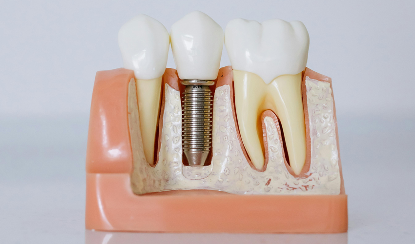 Image of a dental implant in a cross section of gums